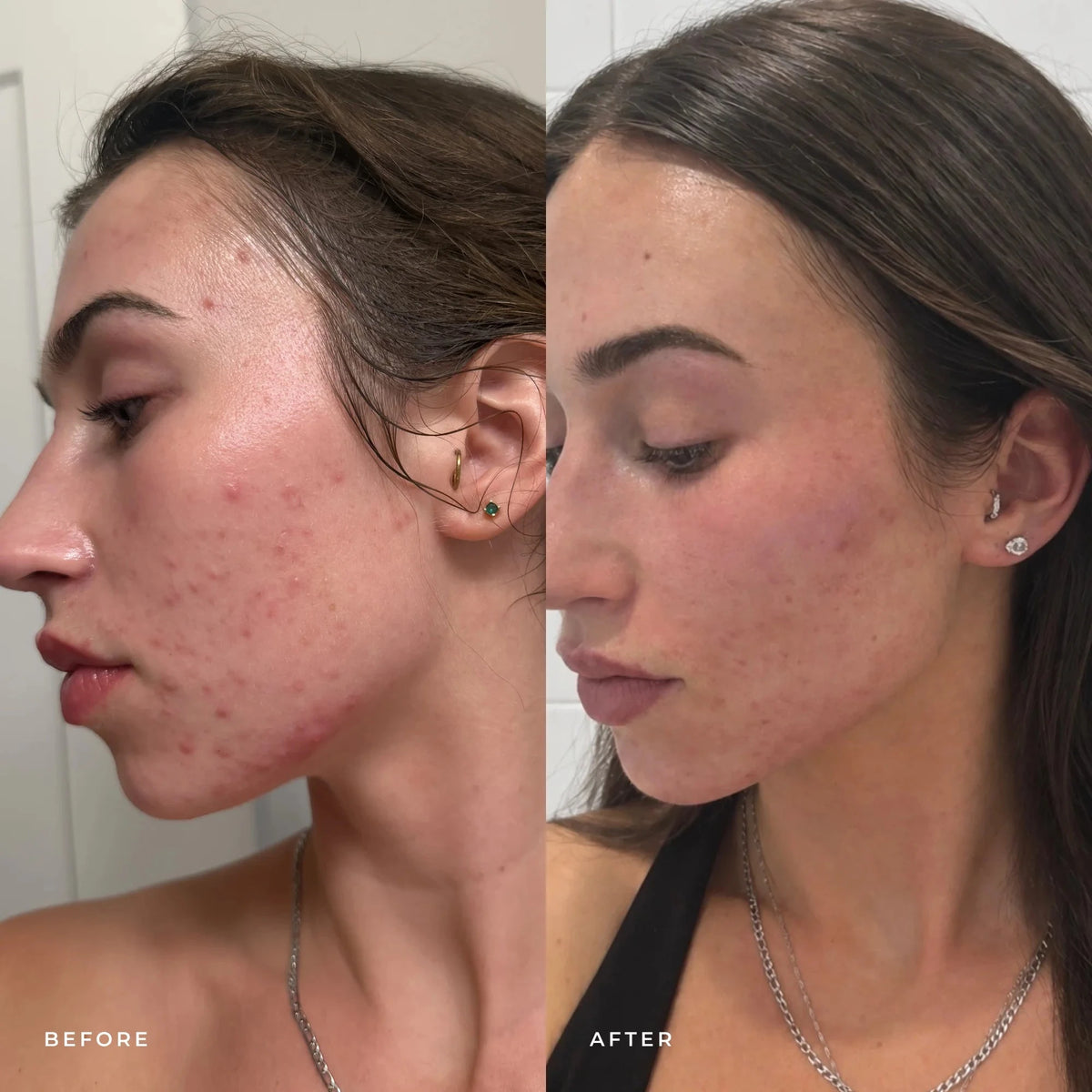 Harmonize Acne Treatment Emme Diane