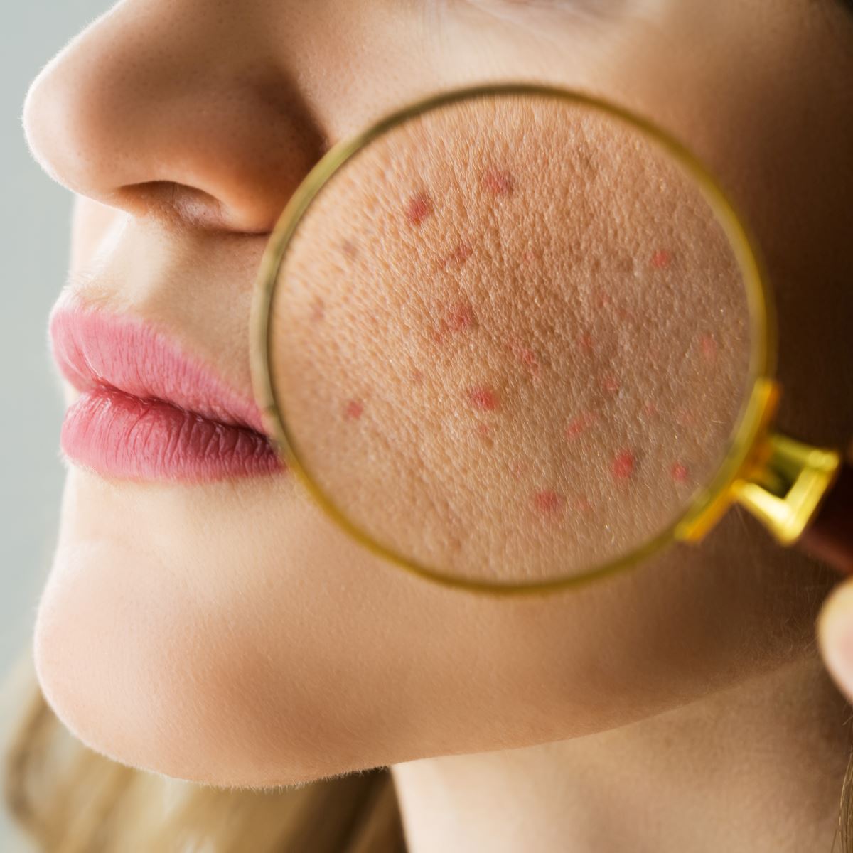 07. What Actually Causes Acne?