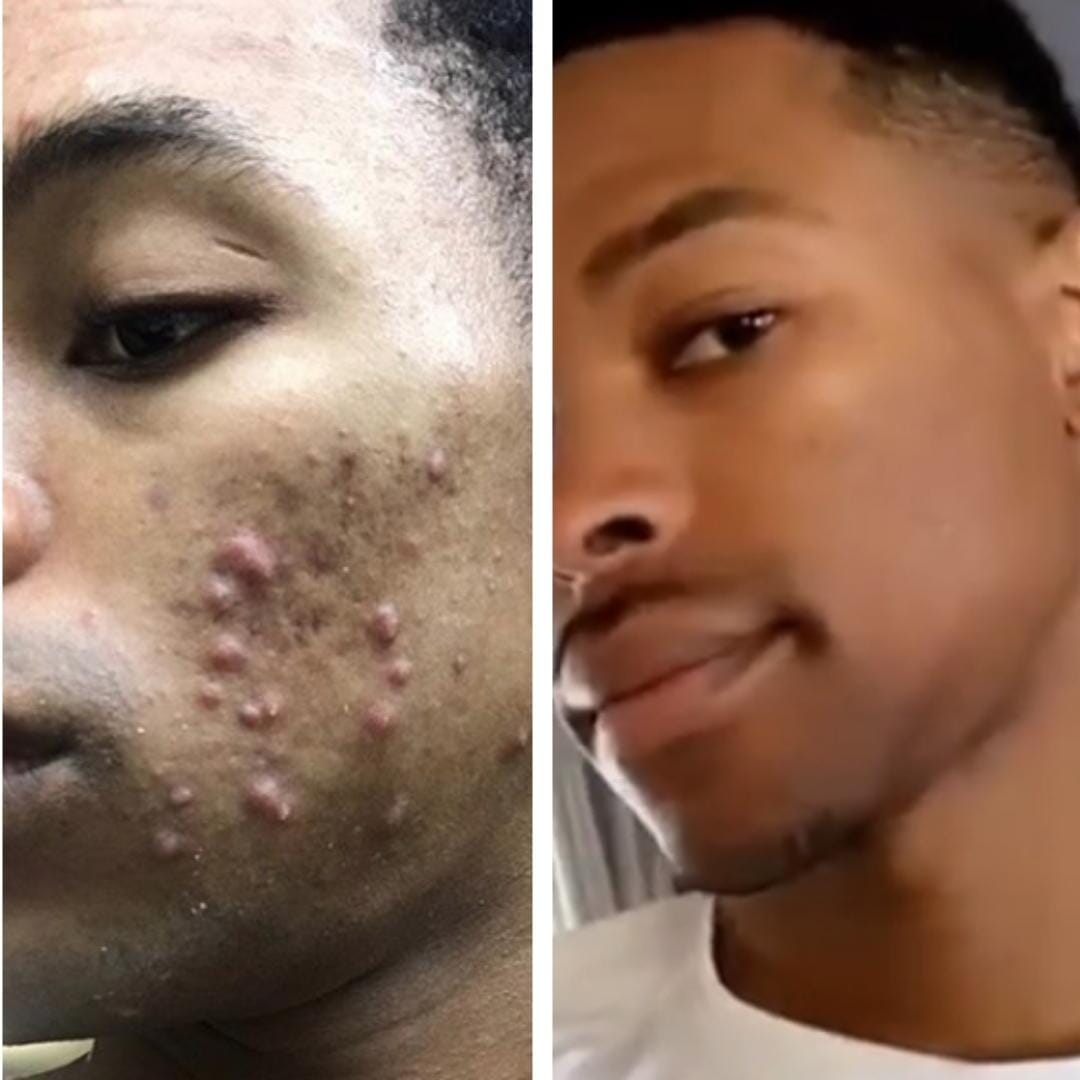 https://emmediane.com/cdn/shop/files/EmmeDianeClearSkincareSet-ClientBeforeandAfter-Male_1.jpg?v=1699041744