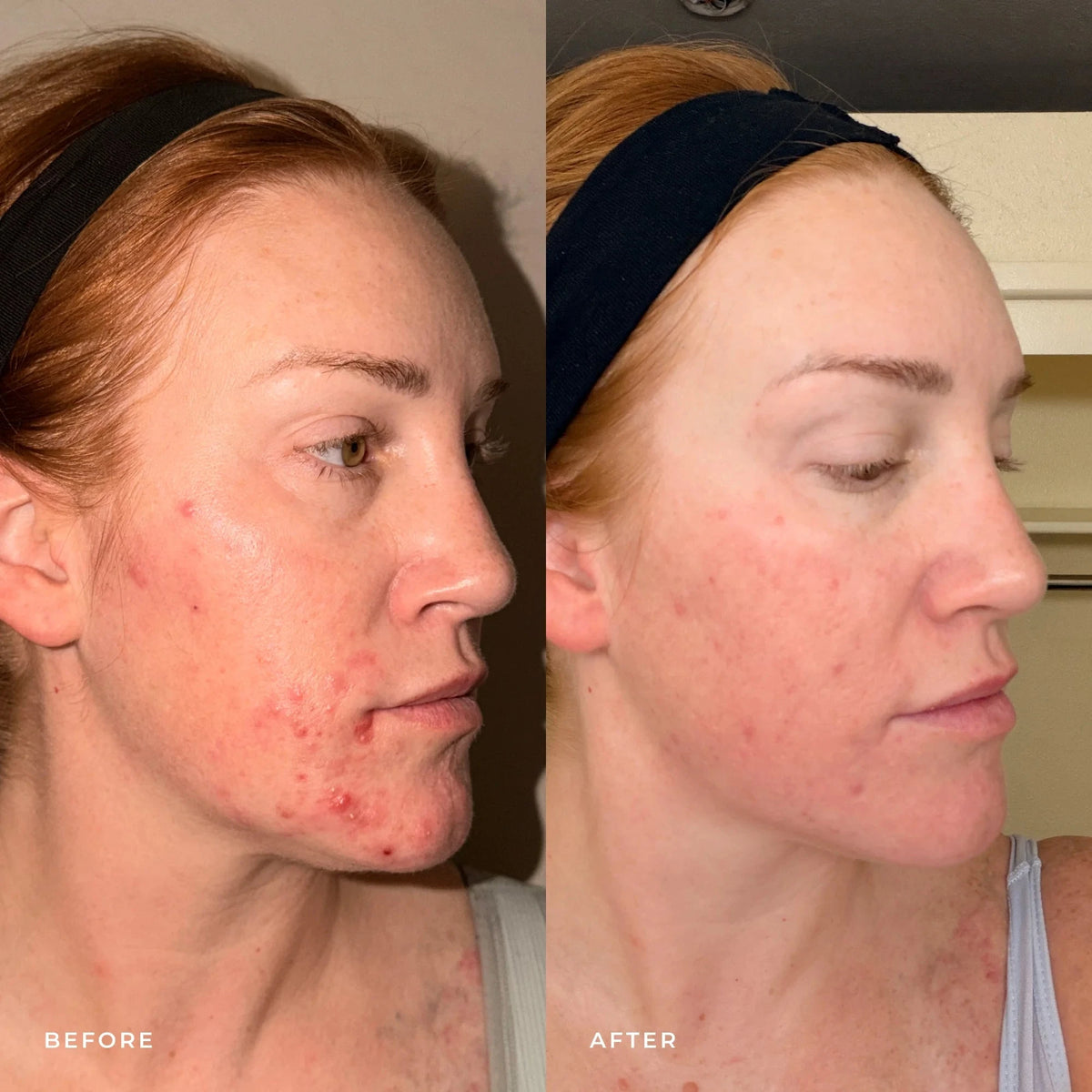 Harmonize Acne Treatment Emme Diane 