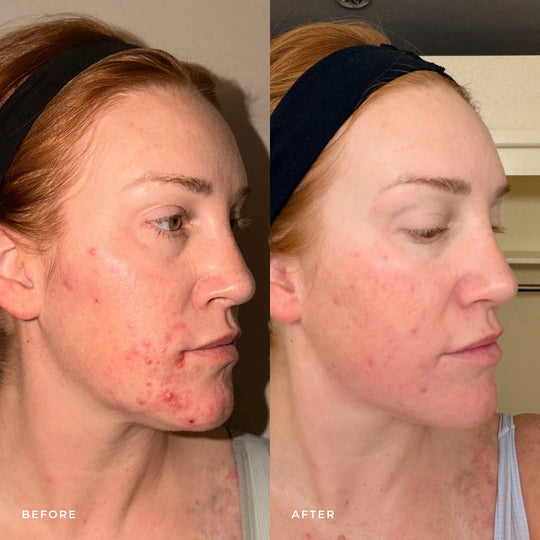 Harmonize Acne Treatment Emme Diane 