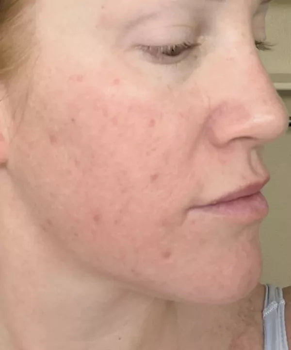 After: the same early tester’s cheek and jawline, with fewer visible breakouts.