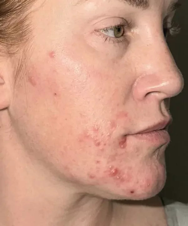 Before: an early tester’s cheek and jawline with active breakouts.